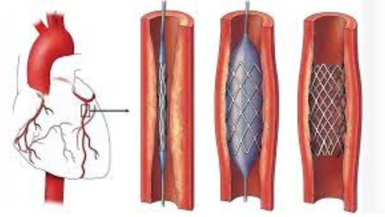 ৪৭ শতাংশ পর্যন্ত কমানো হয়েছে হার্টের রিংয়ের দাম